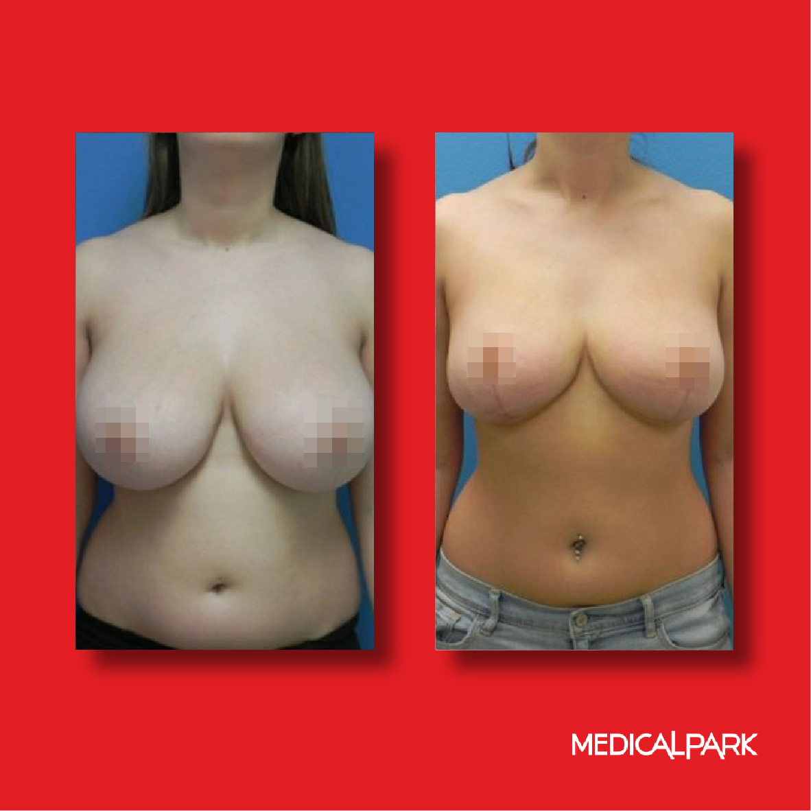 Breast Surgery