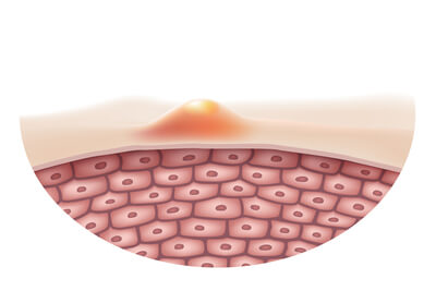 Hidradenitis Suppurativa Treatment.jpg