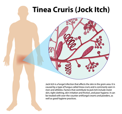 tinea cruris, tinea infection treatment, types of tinea