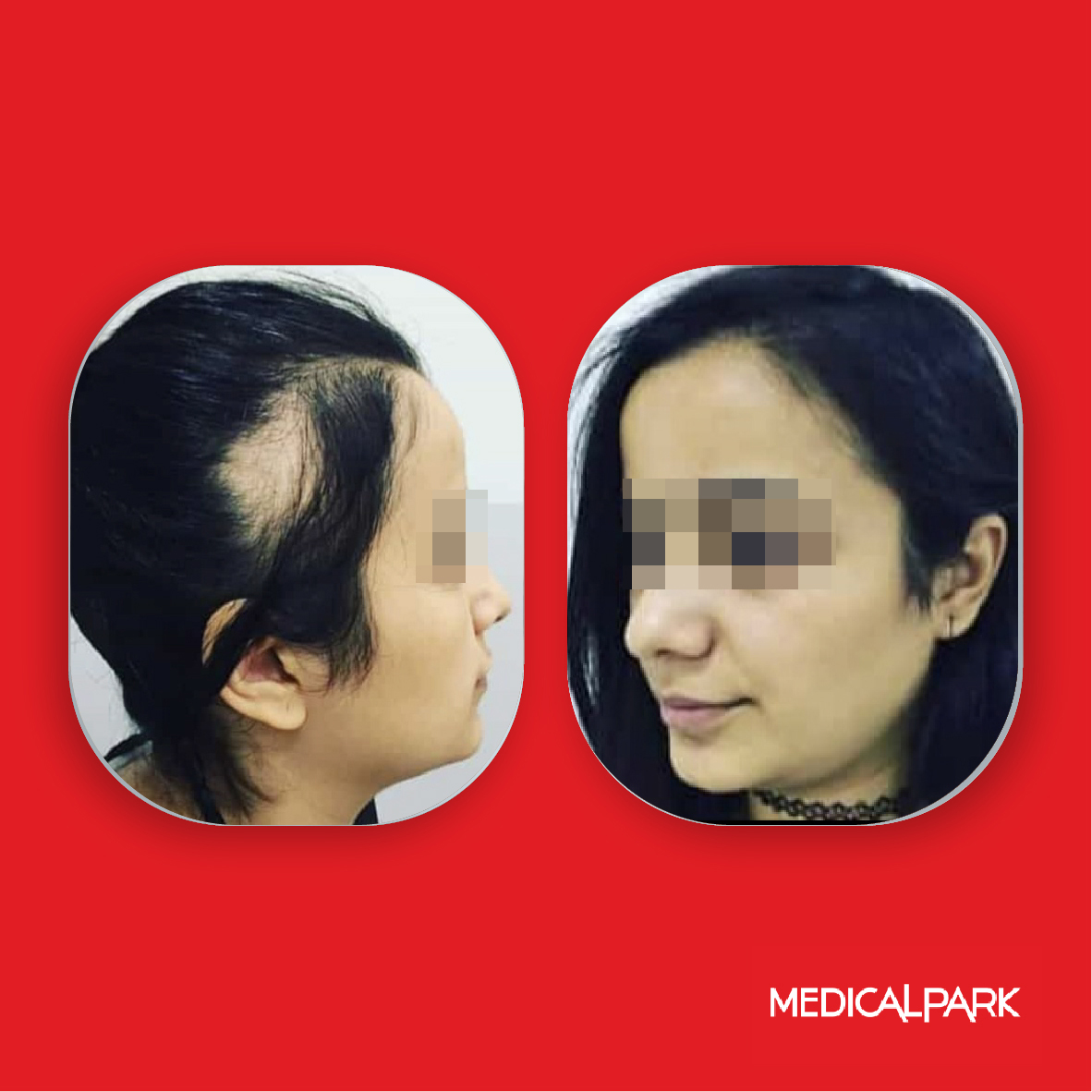 03- Female Hair Transplant.jpg